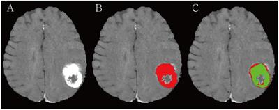 Development of RLK-Unet: a clinically favorable deep learning algorithm for brain metastasis detection and treatment response assessment